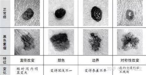 小黑痣|你身上的痣会癌变吗？医生分析了100多颗黑痣，快来。